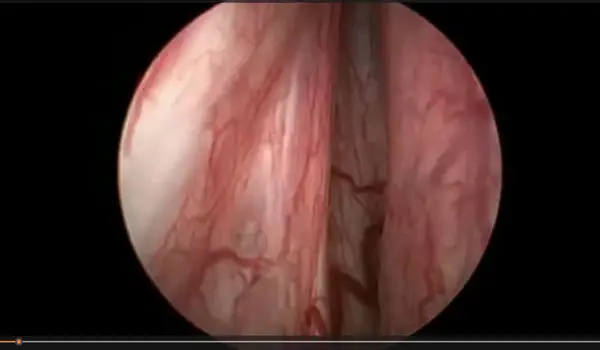 Capa de vídeo do Dr. Alexandre Iscaife palestrando no Congresso Paulista de Urologia